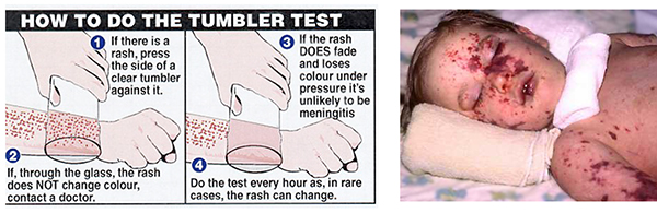 skin prick test #10